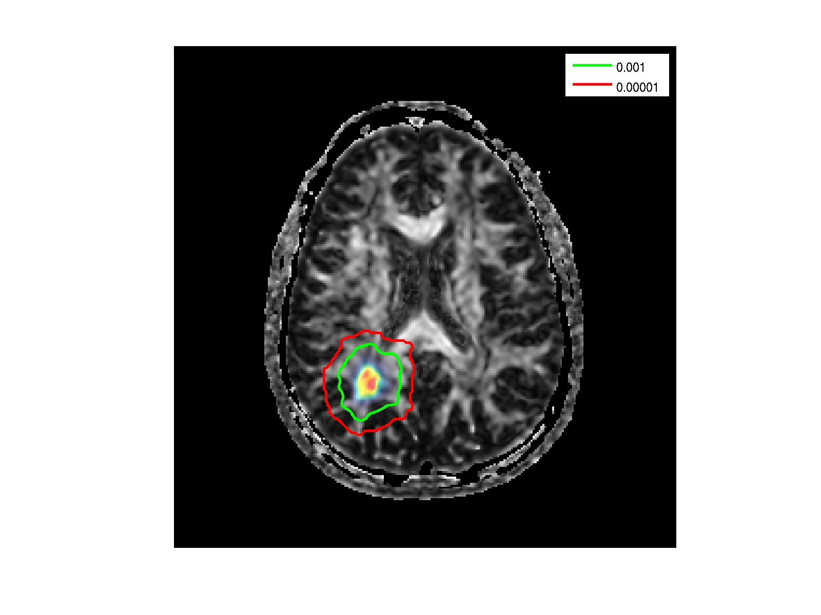 Glioma